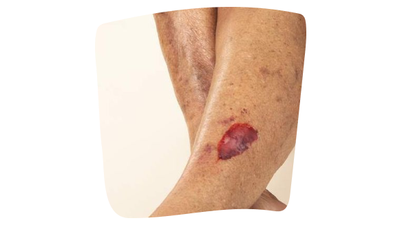 Imagen de una herida crónica en la pierna que cicatriza lento debido a problemas de circulación, como la insuficiencia venosa. Imagen de una herida crónica en la pierna que cicatriza lento debido a problemas de circulación, como la insuficiencia venosa.